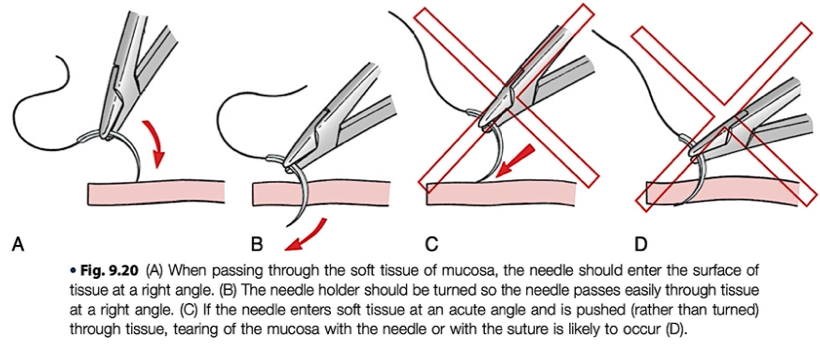 <p>when passing needle thru tissue, needle enters surface <span style="color: rgb(255, 0, 0);">at right angle</span>, to make the smallest possible hole in the mucosal flap</p><p>i<span style="color: rgb(255, 0, 0);">f oblique or acute </span>ā <span style="color: red;">flap tearing</span> and wound <span style="color: red;">edges not properly align </span>and needle is <span style="color: red;">pushed thru </span>rather than<span style="color: red;"> turned</span></p><p><em>(to prevent needle or suture from pulling thru soft tissue flap)</em></p>