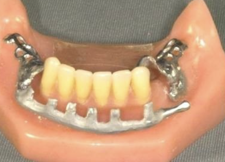 <p>Which anatomical structures are especially important to evaluate before fabricating a swing-lock RPD?</p>