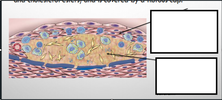<p>parts of an atheroma</p>