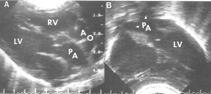 <ul><li><p>there is <span style="color: red;">one wrong connection</span> / mismatch</p><ul><li><p>correct atrium is connected to correct ventricle</p></li><li><p>the <u>wrong great vessel is attached to each ventricle</u></p><ul><li><p>aka <strong>complete transposition</strong></p></li><li><p>unsaturated bl→RA→RV→ <span style="color: rgb(0, 118, 255);">Ao</span></p></li><li><p>saturated bl→LA→LV→<span style="color: rgb(0, 118, 255);">PA</span></p></li></ul></li></ul></li><li><p>associated w/ <span style="color: rgb(167, 0, 255);">cyanosis</span></p></li><li><p>must have large ASD, VSD, or PDA to survive</p></li></ul><p></p>