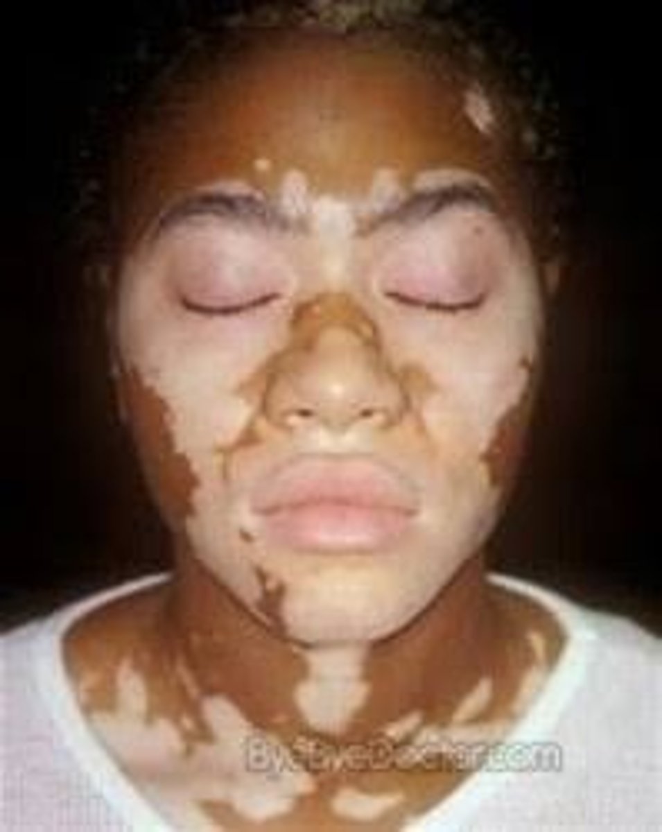 <p>white skin (white patches caused by depigmentation)</p>