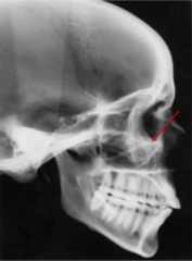 <p>which anatomical landmark:</p><p>- Lowest point of the floor of the orbit</p><p>- Most inferior point of the external border of the orbital cavity</p>