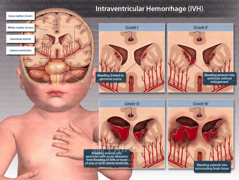 <p>Condition that occurs when there is bleeding in the fluid-filled ventricles inside the brain.</p><p>The smaller and more premature the infant, the higher the risk.</p><p>Severe bleeding often leads to developmental delays, intellectual</p><p>disability, and problems controlling movement.</p>