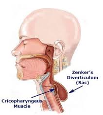 <p>-mucosal outpouching through a weak area just above the upper oesophageal sphincter (cricopharynegus muscle) in the posterior wall of the pharynx</p>