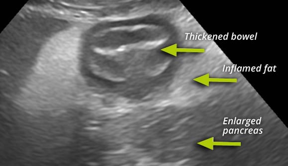 <p>Ultrasonographic signs of pancreatitis</p>