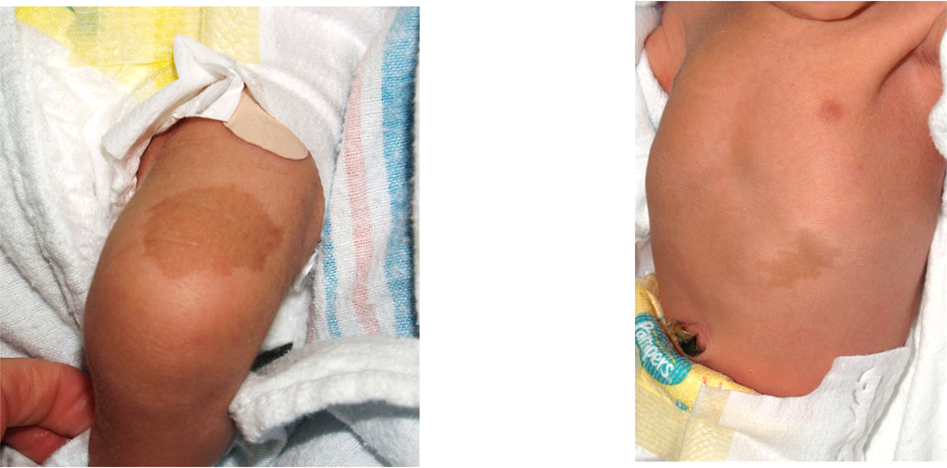 <p>presence of <strong>6 or more</strong> that are >1.5 cm in adults or >0.5 cm in prepubertal children </p>