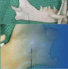 <p>Which block is this, approached extraorally and directed thru the skin</p>