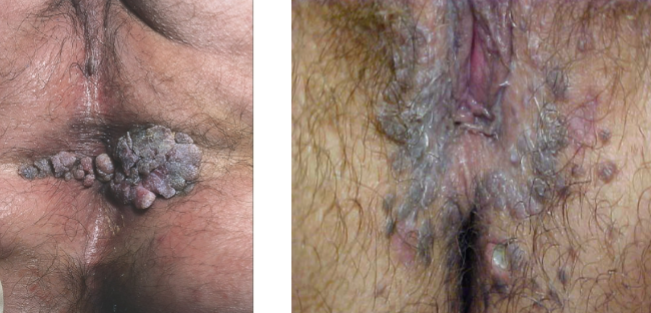 <p>bowenoid papulosis definition</p>