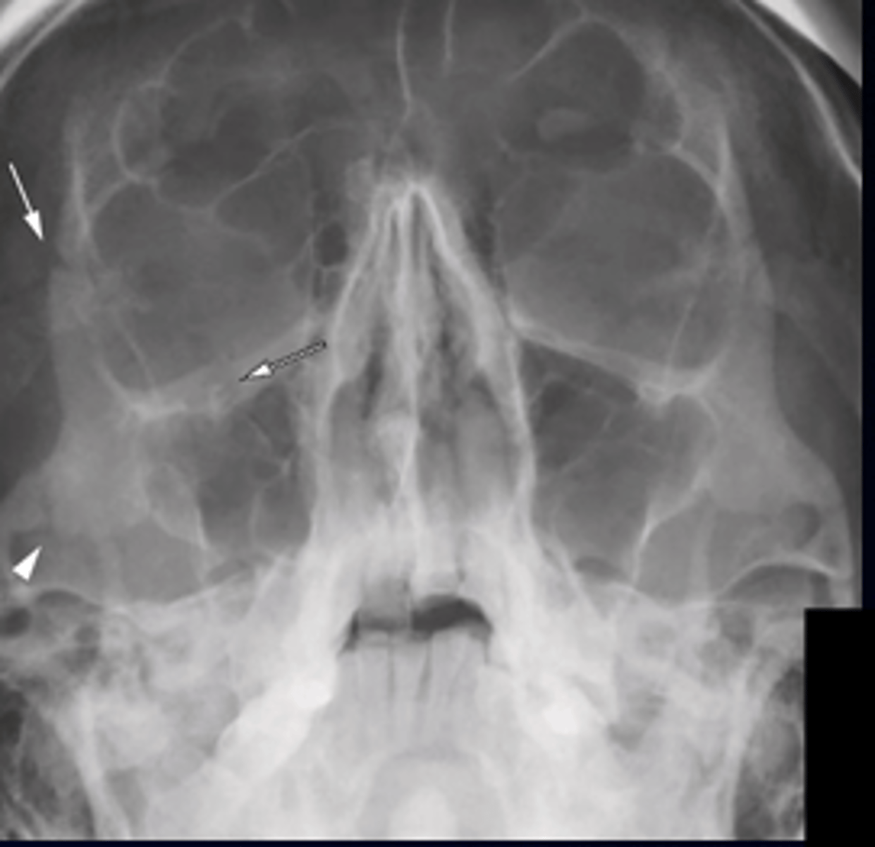 <p>B. Tripod fracture</p>