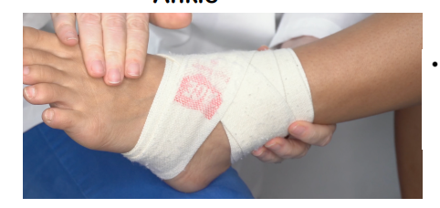 <ul><li><p>Begin wrapping at top of foot</p><p></p></li><li><p>wrap under and around top of foot to secure</p><p></p></li><li><p>while wrapping, create tension in lateral or medial motion, opposite direction of accident</p><p></p></li><li><p>multiple diagonal figure 8 motions around ankle</p><p></p></li><li><p>Finish wrap by fastening.</p></li></ul><p></p>