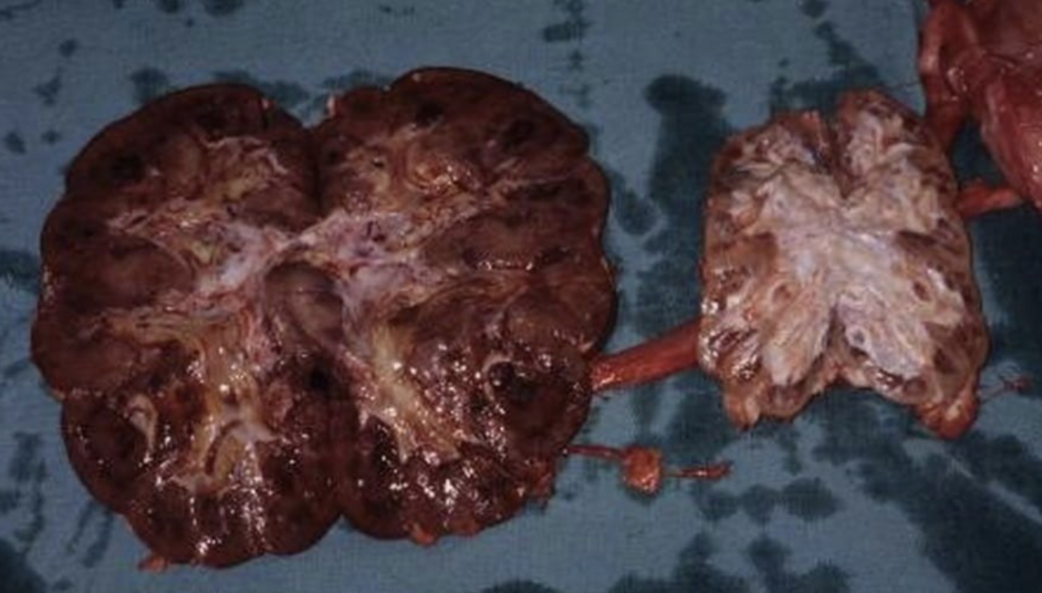 <p>Which kidney is a result of chronice vs. acute pyelonephritis from C. cystitidis?</p>