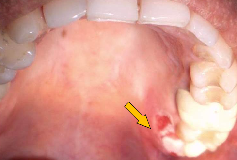 <p>occurs at the site of anesthetic injection; necrosis/ ischemia from epinephrine; erythema, pain, ulceration; usually occurs on the hard palate; heals within 1-2 wks </p>