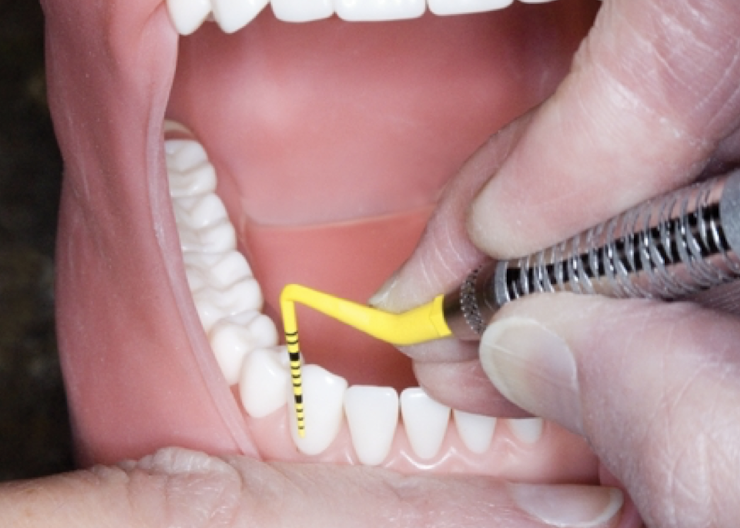 <p>As close to the working area as possible, like 1-4 teeth away from the working place, on the incisal edge, occlusal surface or other embrasure spaces</p>