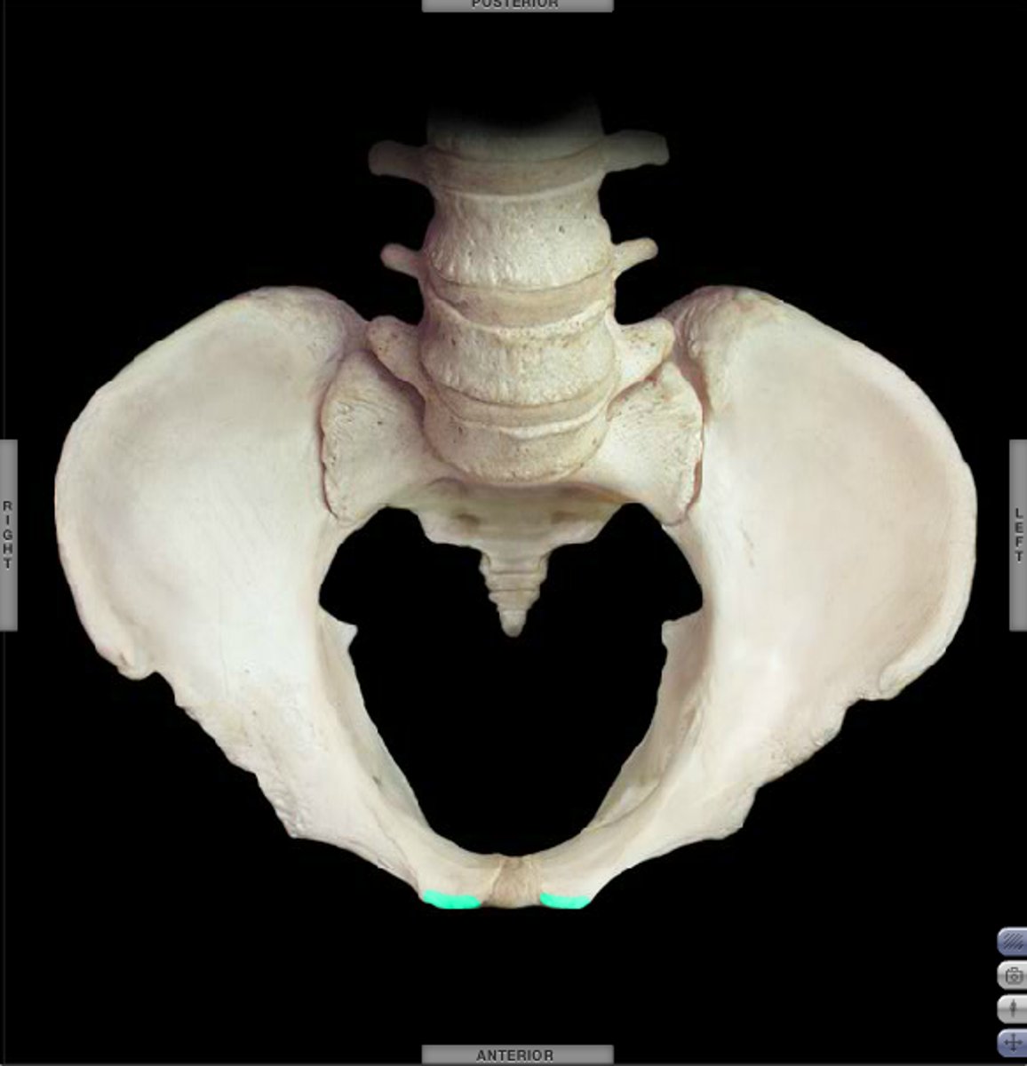 <p>ridge just anteromedial to the pubic tubercle that meets the pubic symphysis - attachment point for transverse abdominis m. and rectus abdominis m.</p>