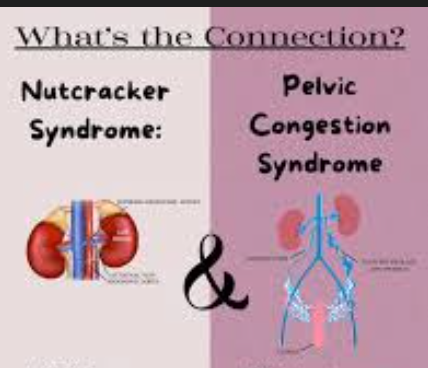 <p>females - pelvic congestion syndrome</p><p>males - left testicle pain, left varicocele</p>