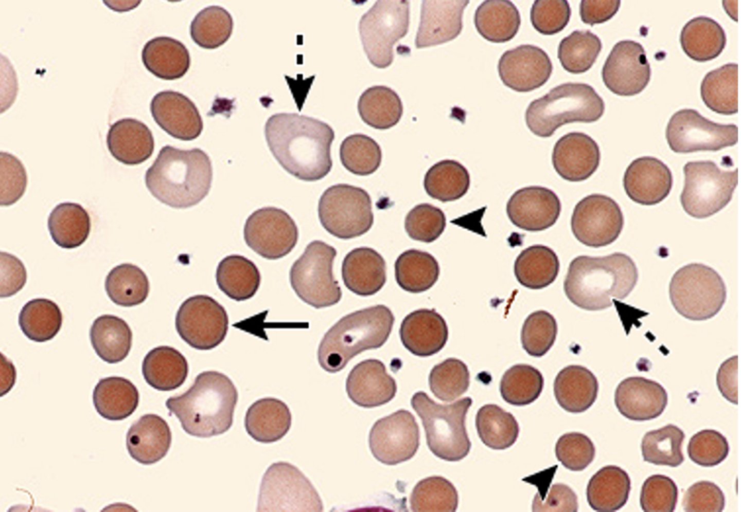 <p>Small, dense, hyperchromic red blood cells lacking the normal central pallor seen in hereditary spherocytosis</p>