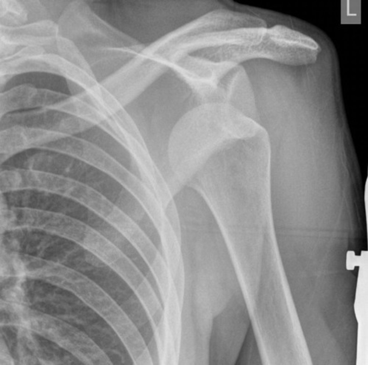 <p>disruption of glenohumeral joint</p>