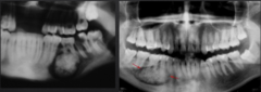 <p>How are these lesions described in terms of density?</p>
