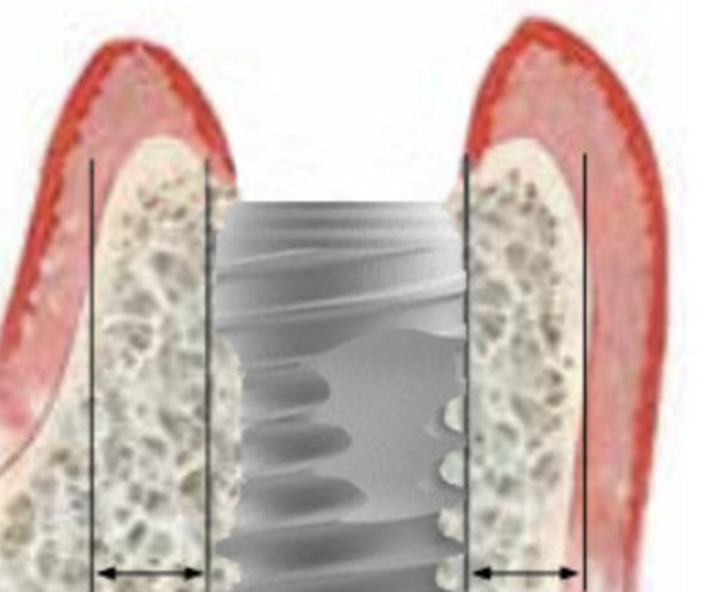 <p>Distance Between implant and gingival (bone between the 2)?</p>