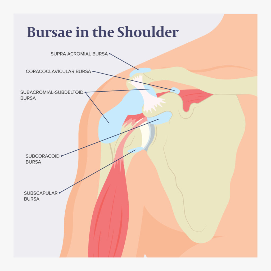 <p>inflammation of the bursa(s) in shoulder</p><p>infraserratus bursa</p><p>supraserratus bursa</p><p>trapezoid bursa</p><p>infaserratus bursa</p><p>subscaular bursa</p><p>subdeltoid bursa</p><p>subcoracoid bursa</p><p>subacromial bursa</p>