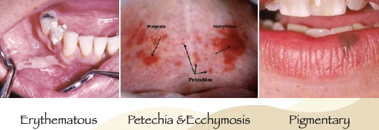 <p>pigmentary</p><p>erythematous</p><p>petechia &amp; ecchymosis</p>