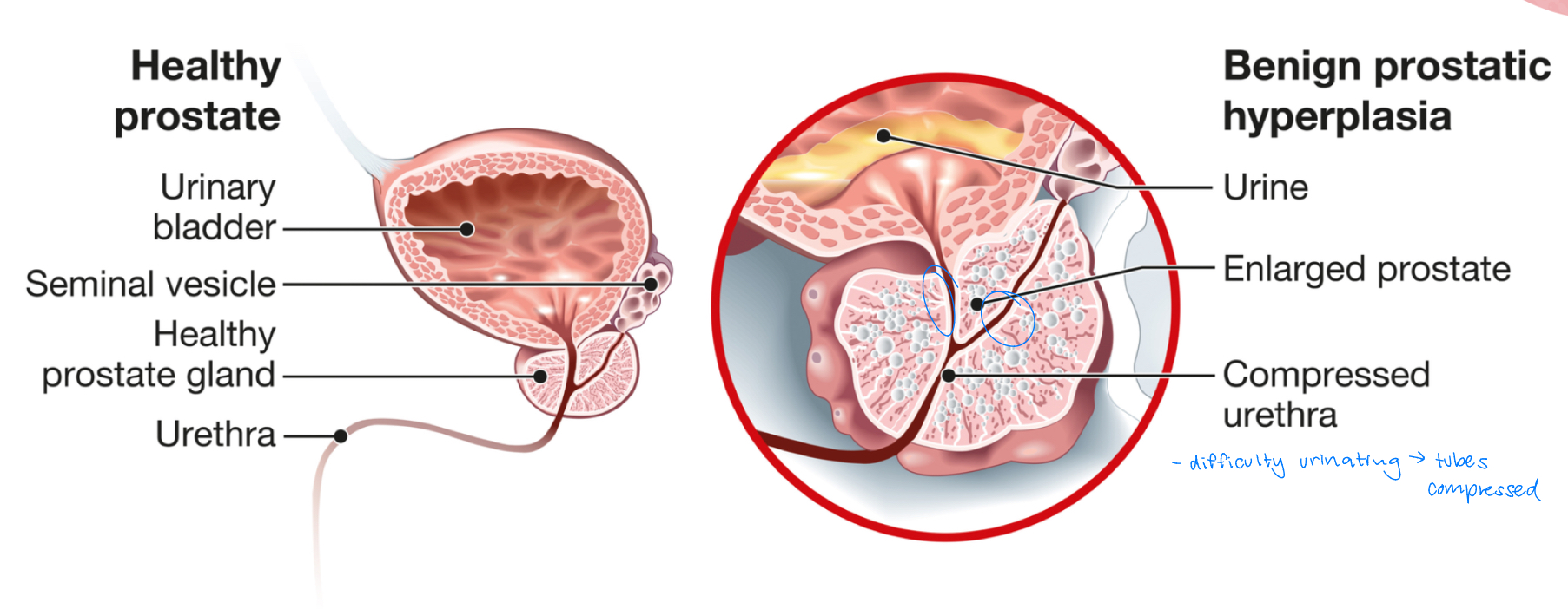 <p>noncancerous enlargement of prostate gland</p><ul><li><p>compresses urethra = difficulty urinating</p></li><li><p>etiology: unknown; most likely due to aging and hormone changes</p></li></ul><p></p>