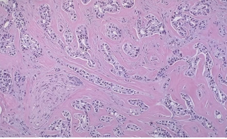 <p>How would you grade this infiltrative ductal carcinoma?</p>