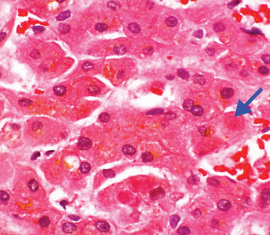 <ul><li><p>Swollen and necrotic hepatocytes with neutrophilic infiltration. </p></li><li><p>Mallory bodies B (intracytoplasmic eosinophilic inclusions of damaged keratin filaments)</p></li></ul><p></p>