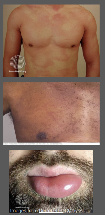 <p>Can affect any body site </p><p>Itchy and burning sensation (burning if deeper in skin)</p><p>Erythematous, edematous papules, and plaques, often surrounded by a vasoconstricted halo (wheals) </p><p>Angioedema – subcutaneous swelling of the skin or mucosa (eyelids, lips) </p><p>Lesions often last less than 24 hours and are characterized by spontaneous appearance and resolution</p>