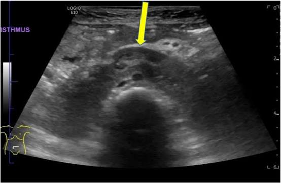 <ul><li><p>lower poles of kidneys are fused </p></li><li><p>isthmus over aorta in trv plane</p></li></ul><p></p>