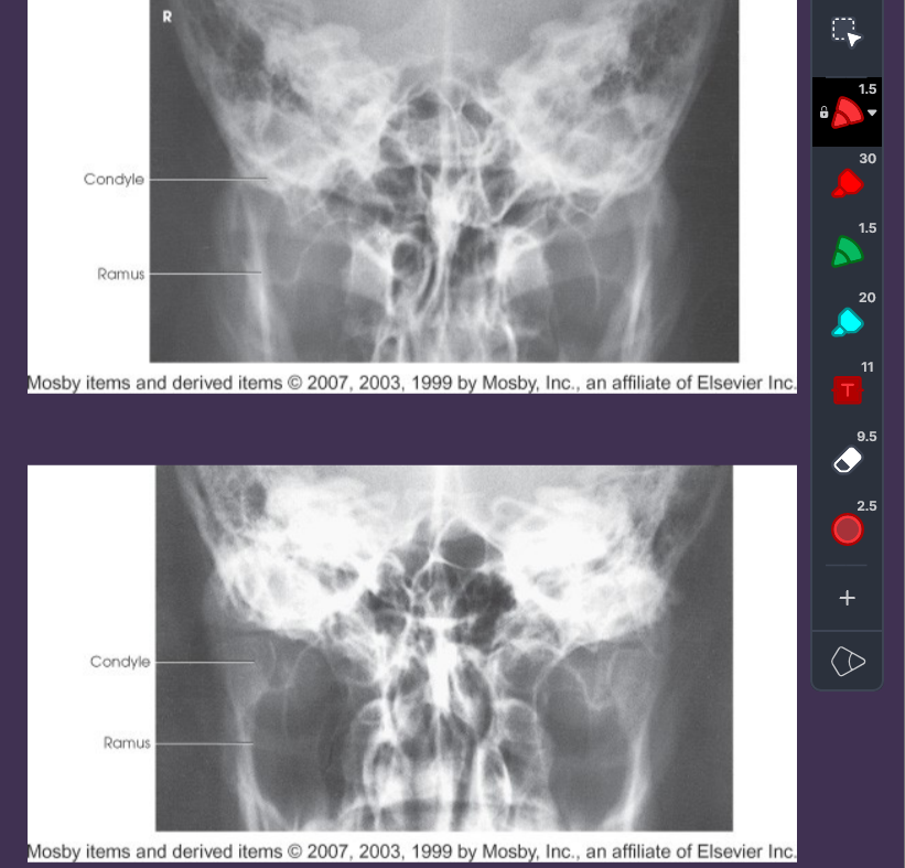 <p>structures shown of AP AXIAL (MODI TOWN) — <strong>TMJ</strong></p>