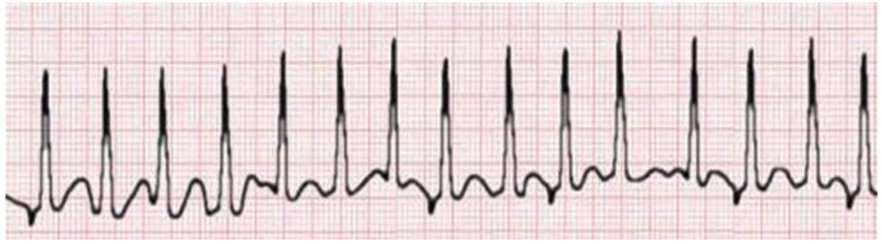 <p>howd yk this was Multifocal Atrial Tachycardia</p>