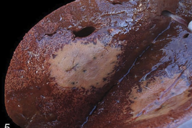 <ul><li><p>Focal necrosis of liver</p></li><li><p>Lesion is pale, surrounded by zone of hyperemia</p></li></ul><p></p>