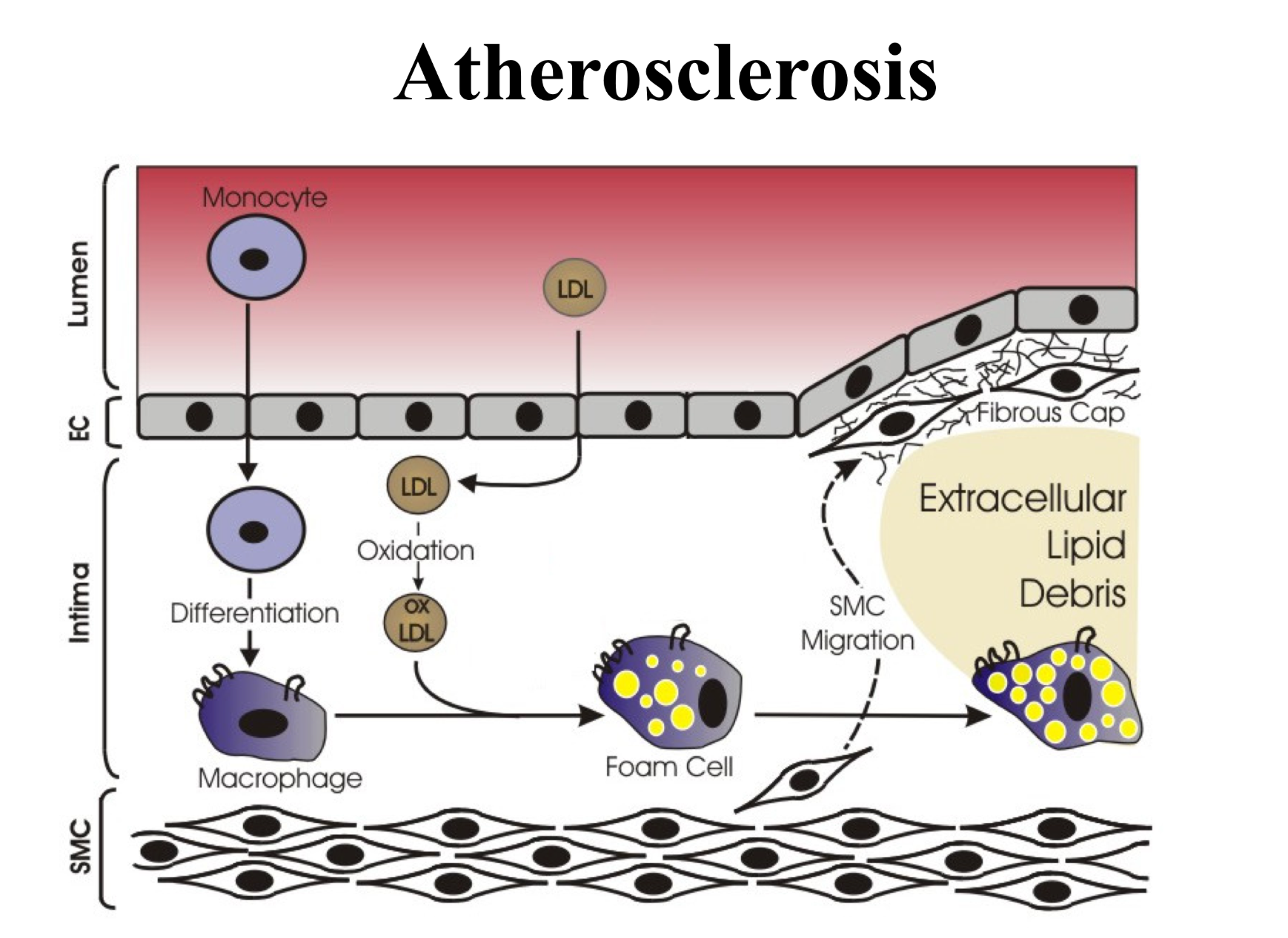 <p>With excess cholesterol input, more LDLs/cholesterol in the blood, LDLs circulate bloodstream for awhile and CEs auto-oxidize by ROS. </p><p>This causes immune response by macrophages which cannot break down oxidized CEs, then become foam cells </p><p>Foam cells die and deposit contents in the vessel wall which becomes plaque </p>