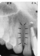 <p>Lateral Fossa</p>