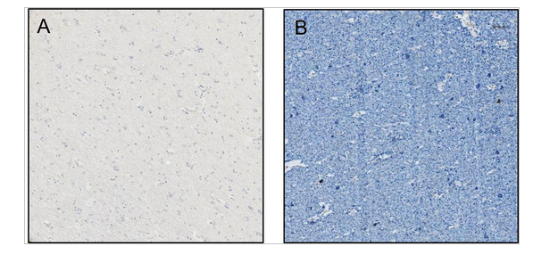 <p>Below are two images from two different brain donors to the SEA-AD study.&nbsp;The images depict pTau (AT8) and p-TDP43 in the middle temporal gyrus.</p><ol><li><p>Based on what we learned about Braak stages, which is the extent of anatomical distribution of neurofibrillary tangles, which image would you say has a higher Braak stage, A or B, and WHY? (2 points)</p></li><li><p>Based on what we learned about the ADNC score (the overall Alzheimer’s disease neuropathologic change score), which patient would you say has a LOW ADNC score and WHY? (2 points)</p></li></ol><p></p>