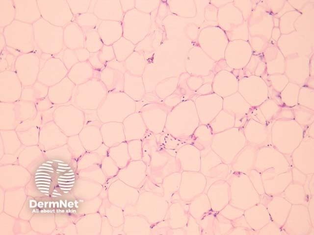 <p>Is this regular lipoma tissue or liposarcoma?</p>