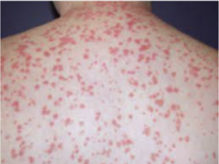 <p>Caso clínico: varón de 26 años, con antecedente de episodios de ologoartritis recidivante de rodillas desde hace 2 años, que se trata con metrotexate semanal. Acude a consulta por la aparición de pápulas redondeadas rojas, de menos de un cm de diámetro, algunas con descamación blanca, pruriginosas, de predominio en tronco y parte proximal de las extremidades. respeta cara, palmas y plantas. refiere un proceso amigdalar la semana previa. Se solicitan análisis de sangre con ASLO: 277 (normal hasta 125), ANAS: negativo, PCR, VSG, hemograma y bioquímica normal. ¿Cuál es la sospecha diagnóstica?</p>