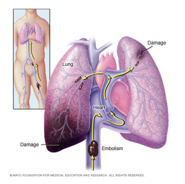 <p>blood clot, fat, septic, amniotic fluid in lungs </p><ul><li><p>usually originates from lower extremity DVT </p></li><li><p>acute (new obstruction that requires immediate tx) vs chronic (older obstruction that has not been resolved; can worsen over time → pulm HTN → R HF ) </p></li><li><p>massive PE → shock, severe pulm HTN, cardiac / resp arrest </p><ul><li><p>mortality rate 30-60%</p></li></ul></li><li><p>>50% of pts have NO sx </p></li><li><p>dx: D dimer (positive = clot that’s beginning to break down), ultrasounds, VQ scan, CT angiogram, pulm angiogram, MRI </p></li><li><p>tx: anticoagulation, thrombolytics, embolectomy, <strong>ventilation → SMALL TIDAL VOLUME AND LOWER PEEP b/c do not want to press emboli to brain </strong></p></li></ul><p></p>