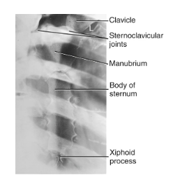 <ul><li><p>Sternum is visualized, superimposed on heart shadow</p></li><li><p>Shifts sternum to the left of the thoracic vertebrae</p></li></ul><p></p>