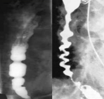 <p>nutcracker esophagus? corkscrew esophagus? </p>