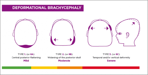 <p><strong>Argenta Classification</strong></p><p></p><ul><li><p><strong>1 - Mild Deformity</strong></p><ul><li><p>Central Posterior Flattening</p></li></ul></li></ul><p></p><ul><li><p><strong>2 - Moderate Deformity</strong></p><ul><li><p>“1” + Posterior Widening</p></li></ul></li></ul><p></p><ul><li><p><strong>3 - Severe Deformity</strong></p><ul><li><p>“3” + Vertical / Temporal</p></li></ul></li></ul><p></p>