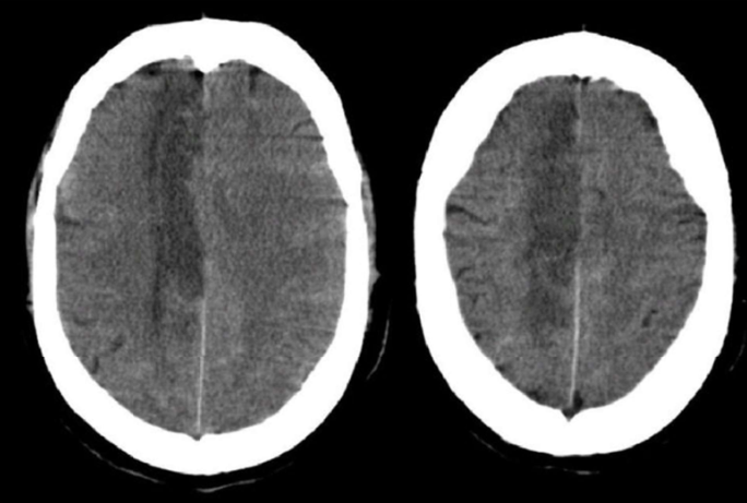 <p>pt has contralateral hemiparesis and hemisensory loss of the lower extremity. may be a contralateral grasp reflex, marked confusion, apraxia. urinary incontinence</p>