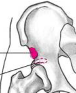 <p>anterior inferior iliac spine</p>