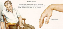 <p>radial nerve compression in the axilla (common)</p>