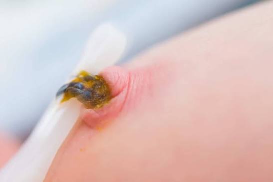 <p>Infección e inflamación del ombligo y los tejidos que lo rodean.</p>