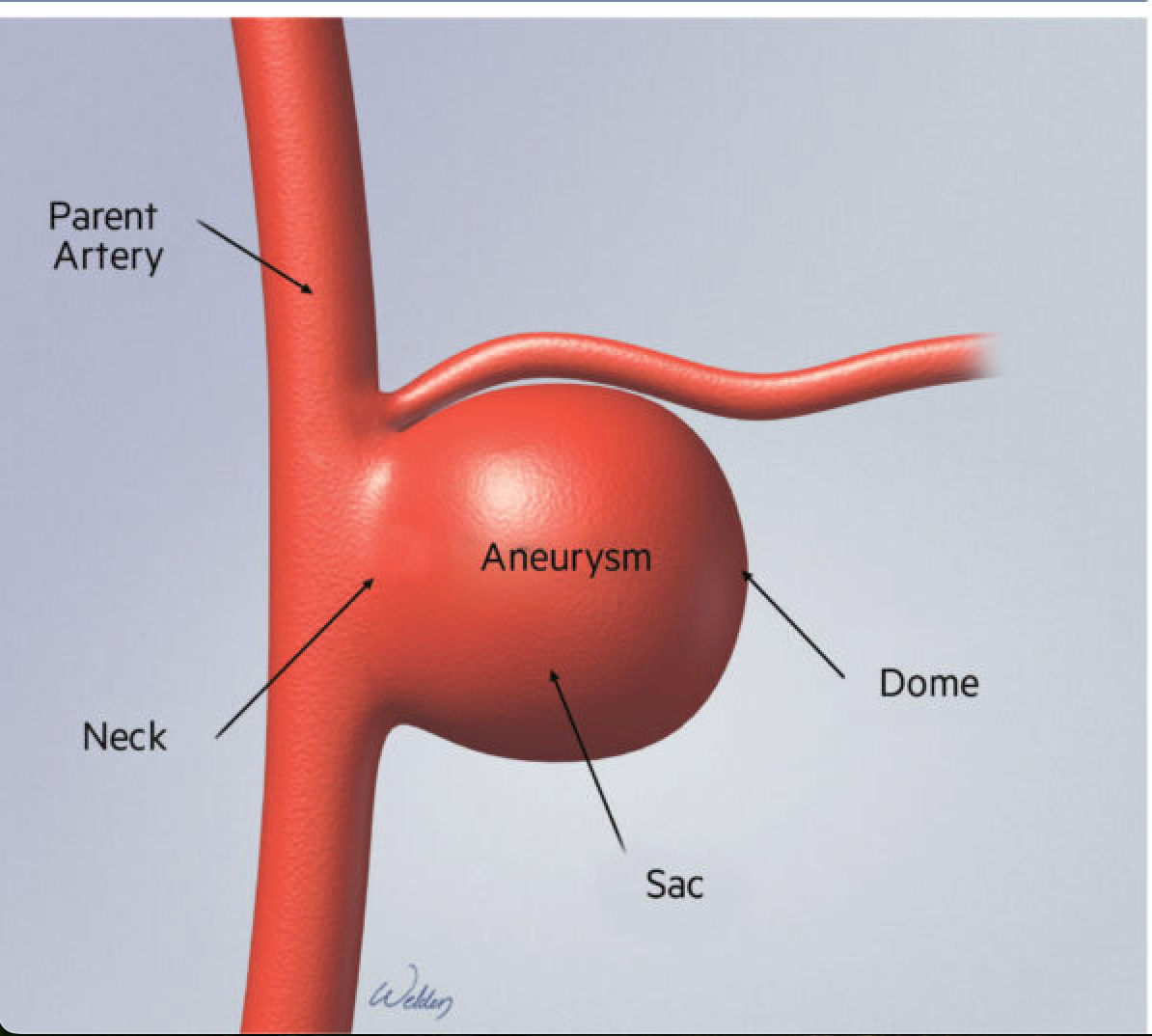 <p><span>These are round, pouch-like, or "berry-shaped" outpouchings that develop at arterial junctions in the brain,</span></p>