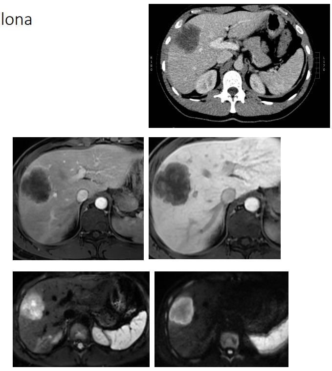 <ol><li><p>Imenuj tehniko slikanja </p></li><li><p>Naštej anatomske strukture, prikazane na sliki </p></li><li><p>Kakšna je razlika med slikami? </p></li><li><p>Položaj slikanja? </p></li><li><p>Opiši patološke spremembe na sliki </p></li><li><p>Diagnoza?</p></li></ol><p></p>