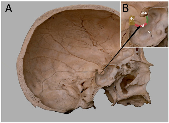 <p>What is the saddle like depression in the sphenoid bone where the pituitary gland sits called? </p>
