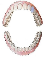 <p>maxillary left canine</p>